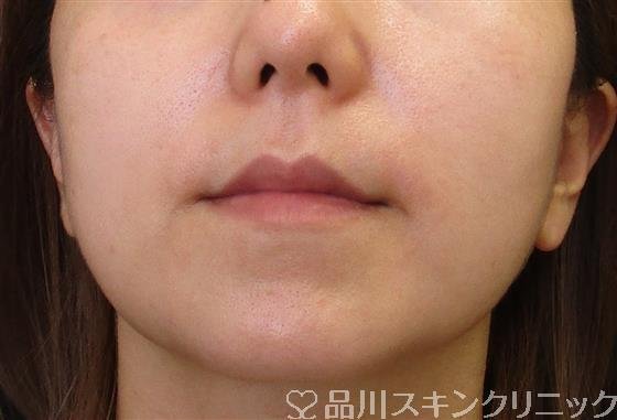 症例NO.59136のBEFORE写真