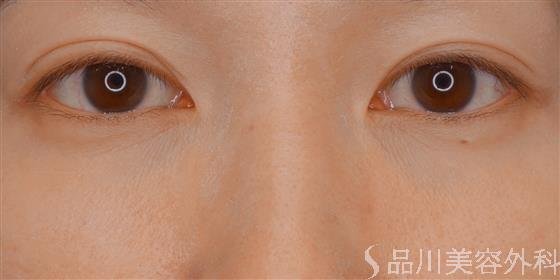 症例NO.59972のAFTER写真