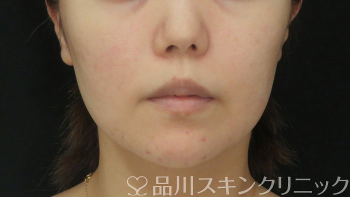 症例NO.72624のBEFORE写真