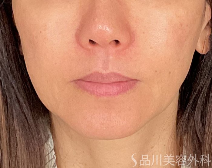 症例NO.74460のBEFORE写真