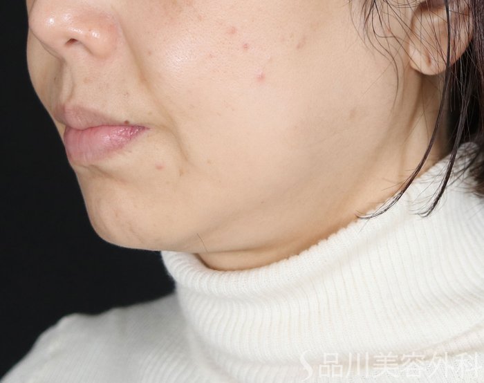 症例NO.73485のBEFORE写真