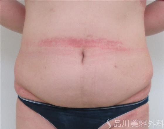 症例NO.23442のAFTER写真