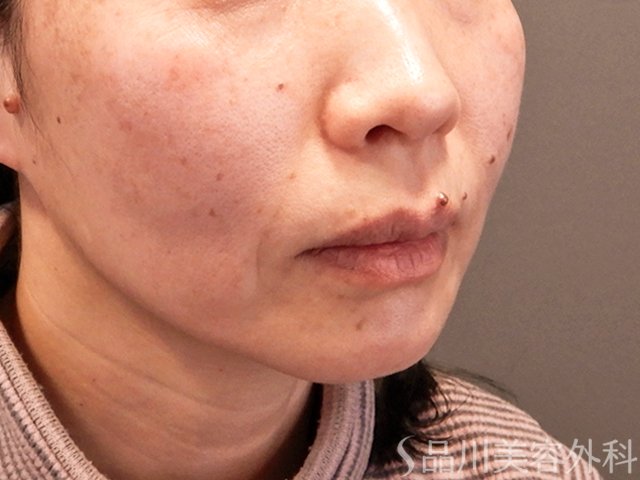 症例NO.70489のBEFORE写真