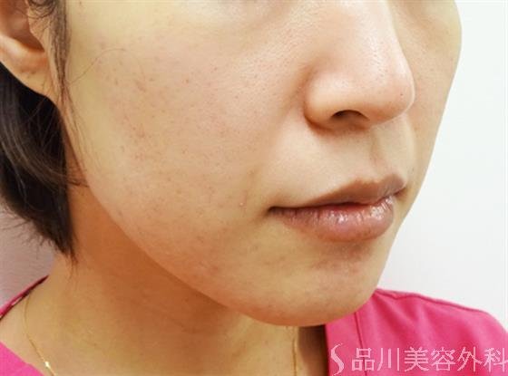 症例NO.32826のBEFORE写真