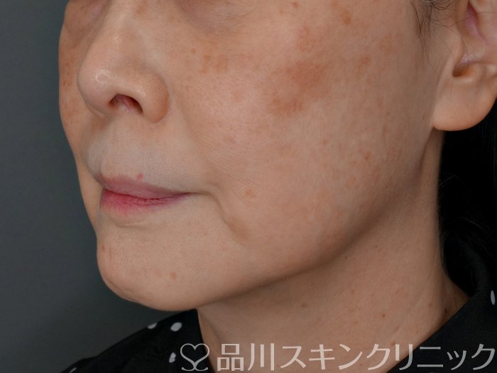 症例NO.73049のBEFORE写真