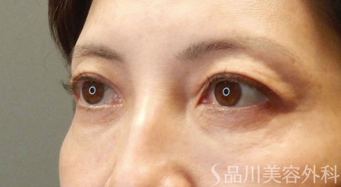 症例NO.69496のBEFORE写真