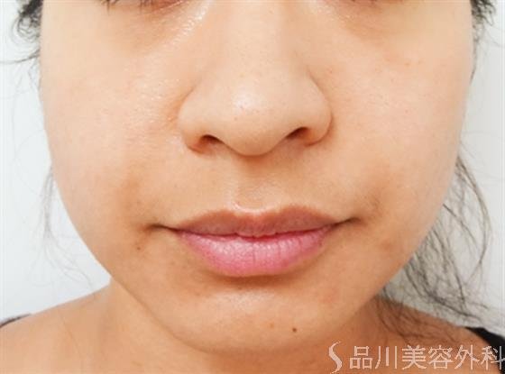症例NO.33420のBEFORE写真
