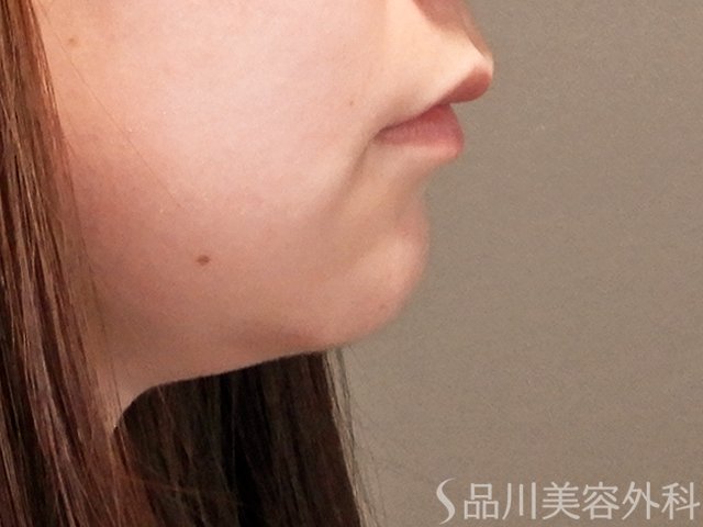 症例NO.70323のBEFORE写真