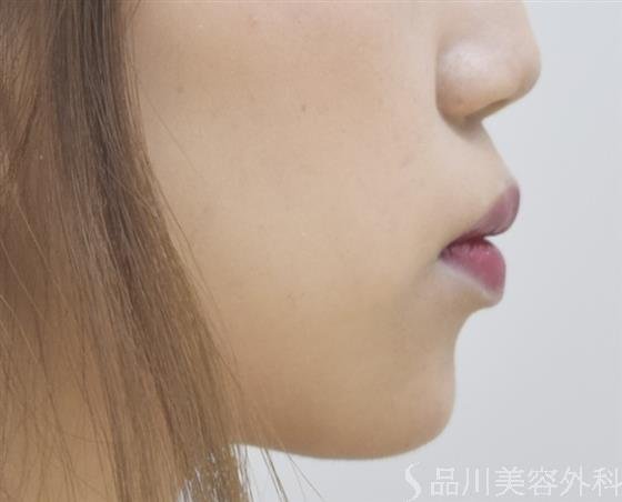 症例NO.45652のAFTER写真