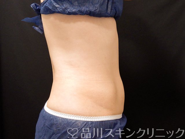 症例NO.68115のAFTER写真