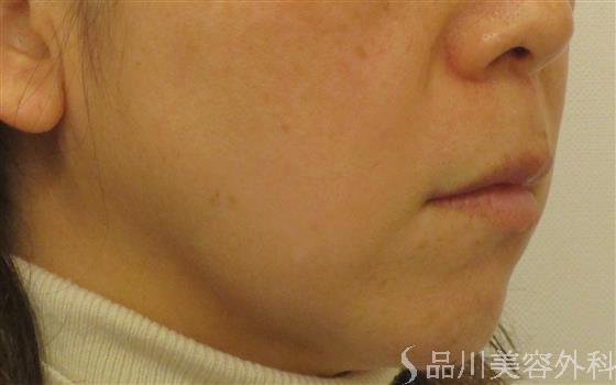 症例NO.59009のBEFORE写真