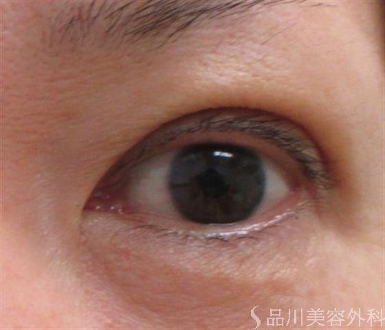 症例NO.23203のAFTER写真