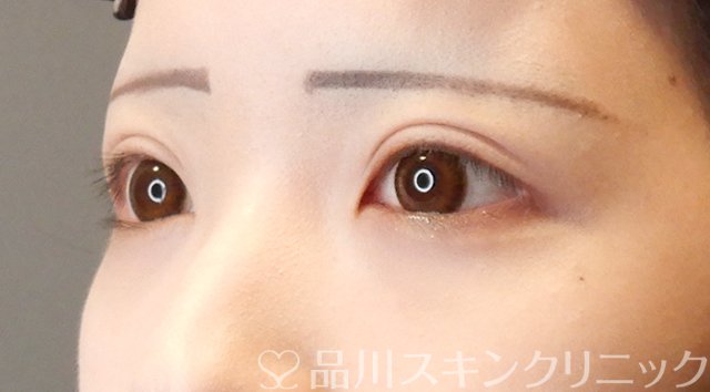 症例NO.66011のAFTER写真