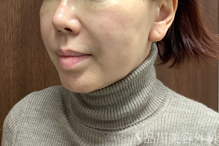 症例NO.71291のBEFORE写真
