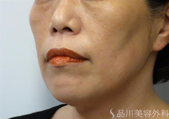 症例NO.40037のBEFORE写真