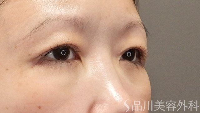 症例NO.75107のAFTER写真