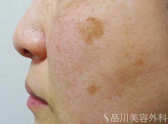症例NO.70063のBEFORE写真