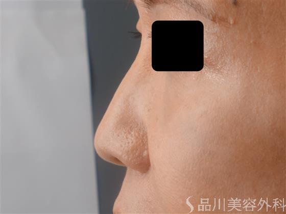 症例NO.60950のBEFORE写真