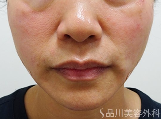 症例NO.73051のAFTER写真