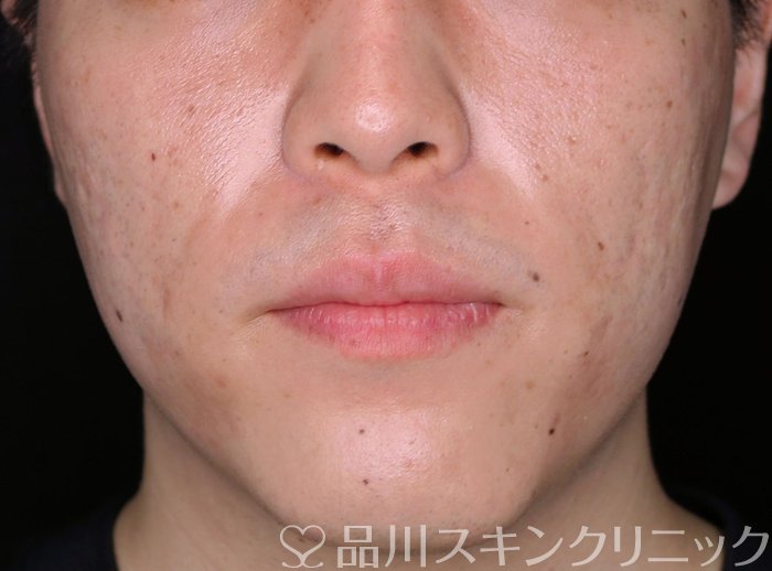 症例NO.65719のAFTER写真