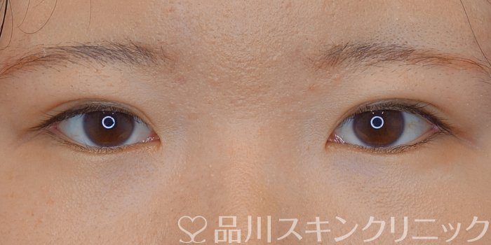 症例NO.71543のAFTER写真