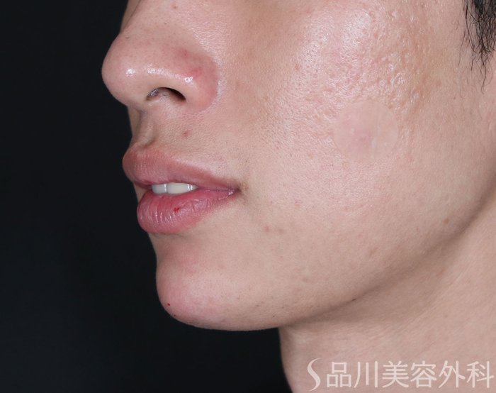 症例NO.70848のAFTER写真