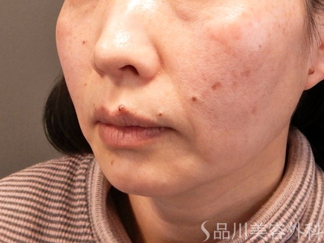 症例NO.70489のBEFORE写真