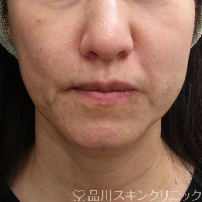 症例NO.74723のBEFORE写真