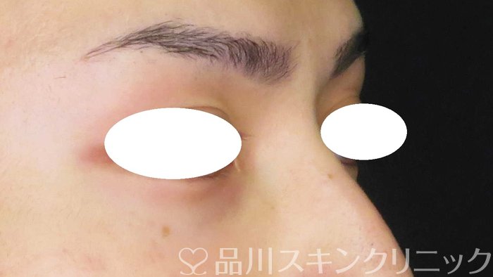 症例NO.63682のBEFORE写真