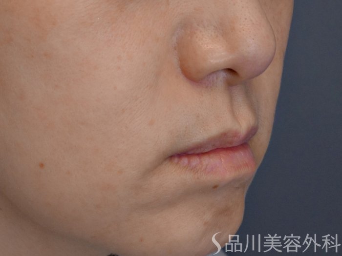 症例NO.72391のBEFORE写真