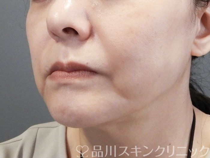 症例NO.75179のBEFORE写真