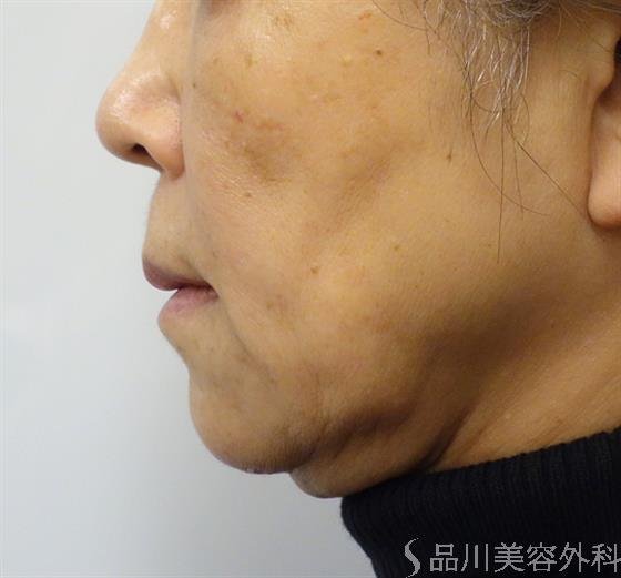 症例NO.40102のBEFORE写真