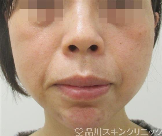 症例NO.27641のAFTER写真
