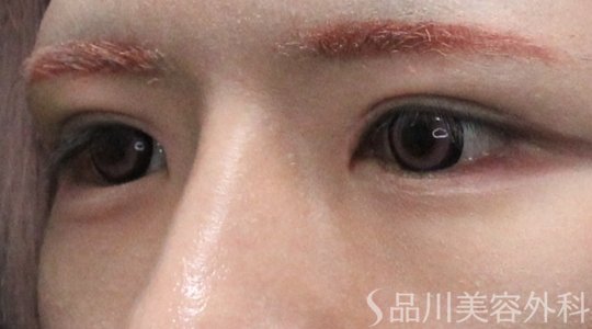 症例NO.75213のAFTER写真