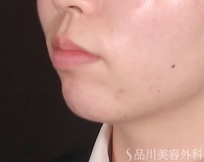 症例NO.70377のBEFORE写真