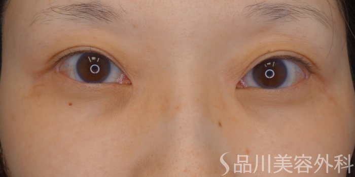 症例NO.74995のBEFORE写真