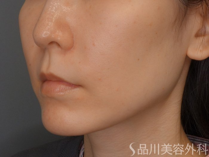 症例NO.73721のBEFORE写真