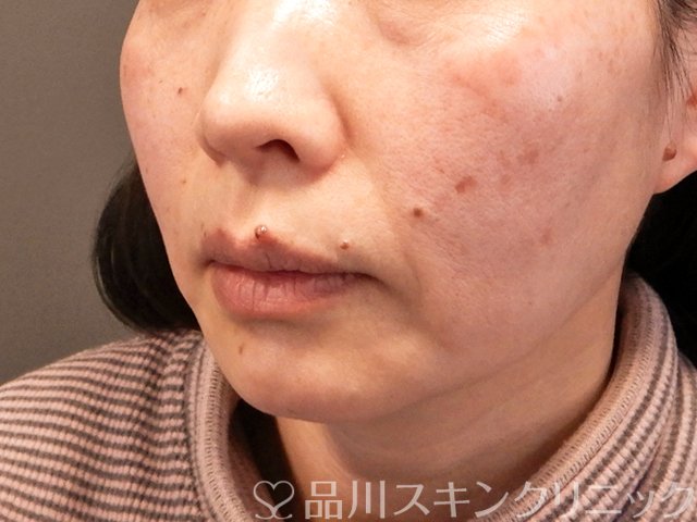 症例NO.70489のBEFORE写真