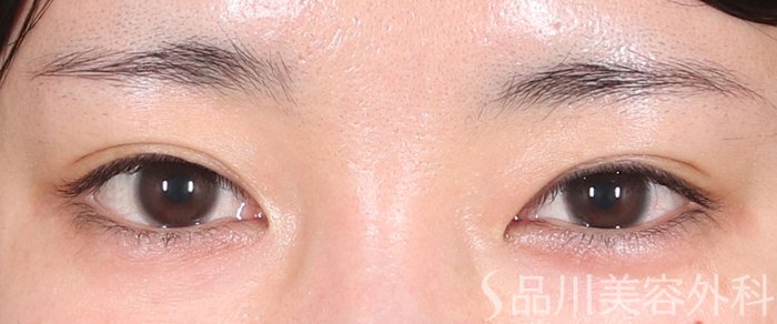 症例NO.73590のBEFORE写真