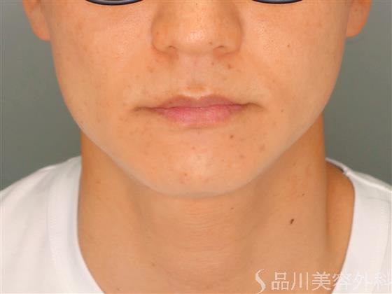 症例NO.55347のBEFORE写真