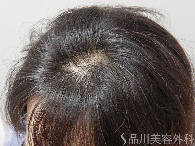 症例NO.72889のBEFORE写真