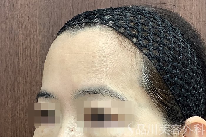症例NO.67780のBEFORE写真