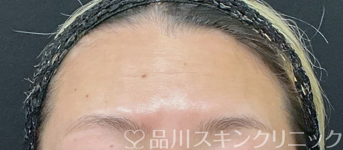 症例NO.73771のBEFORE写真