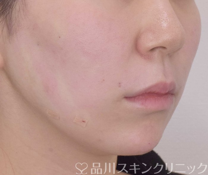 症例NO.69738のAFTER写真