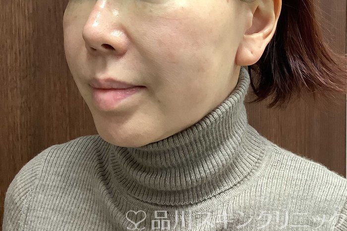 症例NO.71291のBEFORE写真