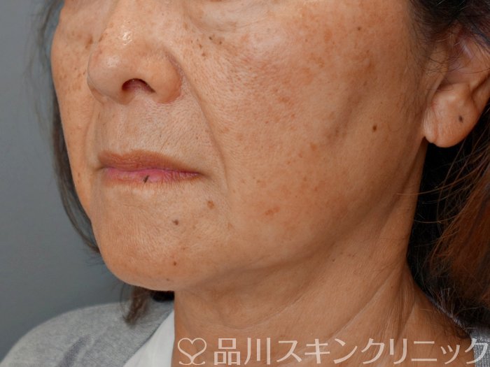 症例NO.73018のBEFORE写真