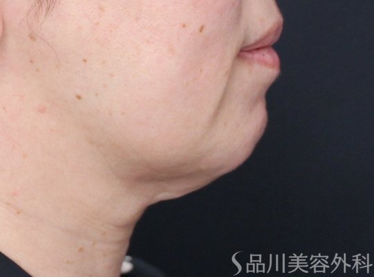 症例NO.72228のBEFORE写真