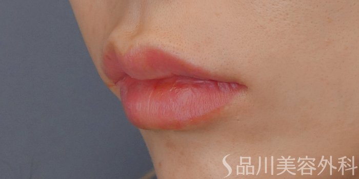 症例NO.72195のAFTER写真