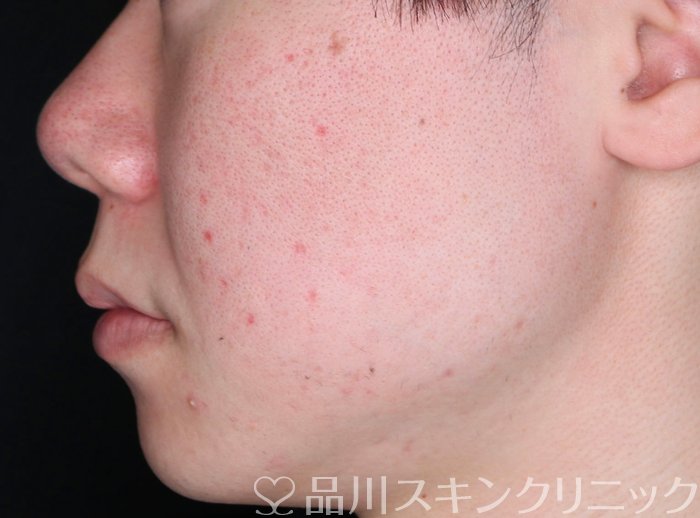 症例NO.73960のAFTER写真