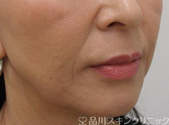 症例NO.39792のBEFORE写真
